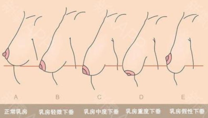 ①丰满,挺拔,匀称,柔软并富有弹性②乳房位于第2至第6肋间,胸骨旁线