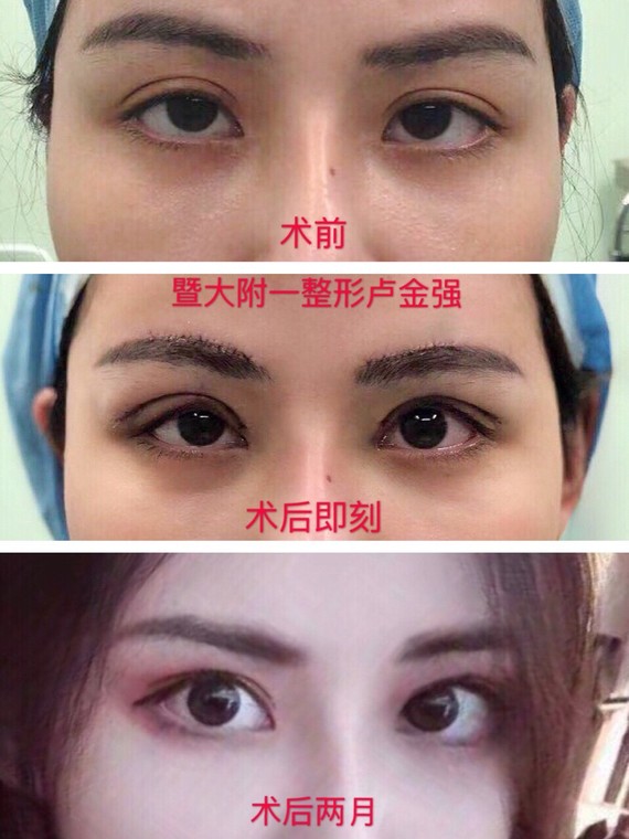 全切双眼皮无痕切眉提升死鱼眼改造