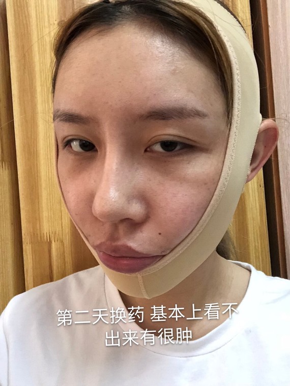 案例分享大小脸不对称面部吸脂拯救你