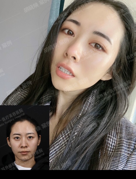 面部抗衰
