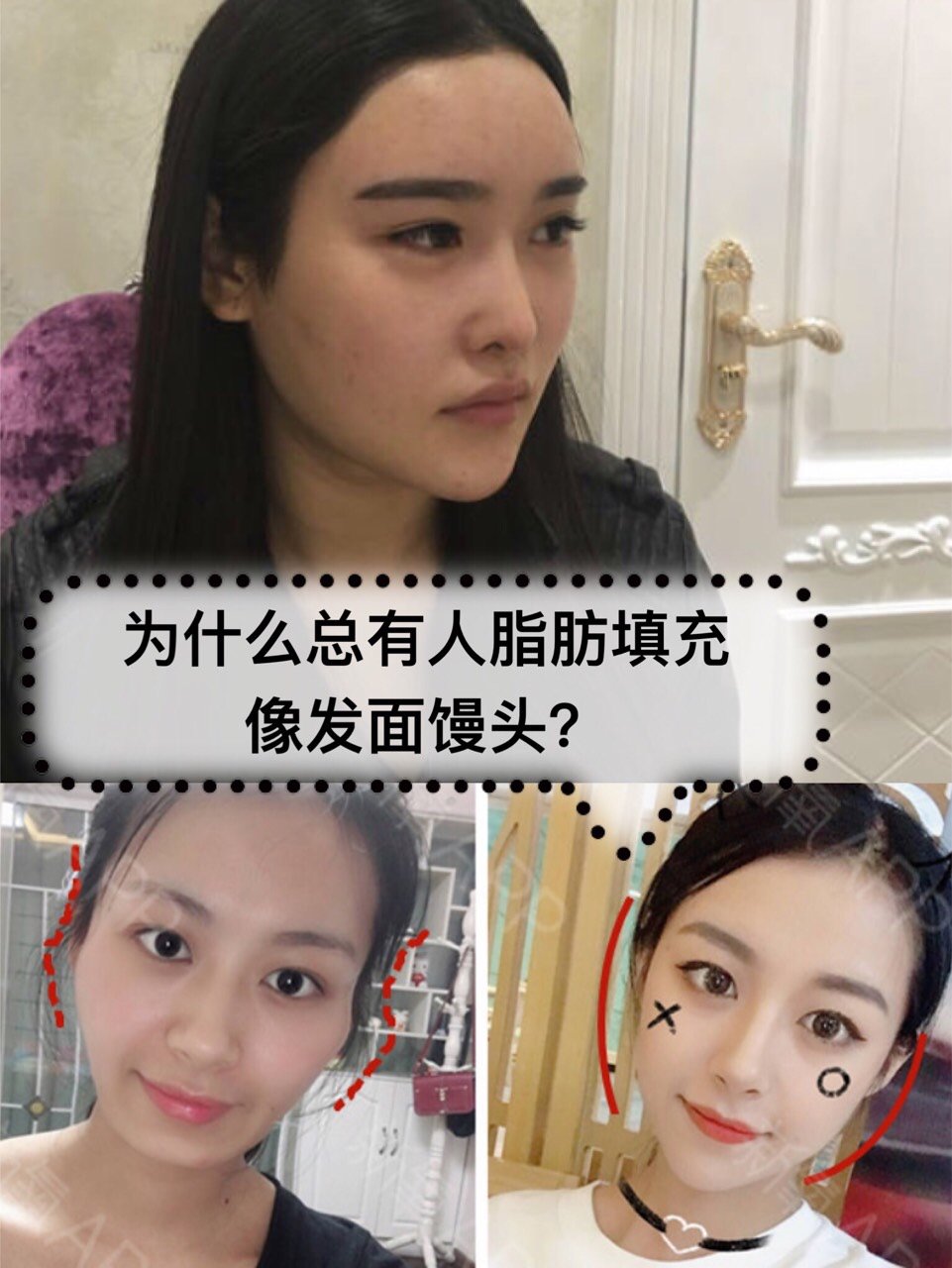 为什么你做的脂肪填充总是脸崩?很臃肿?