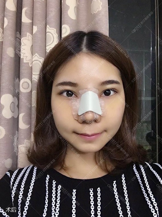【隆鼻选软肋,软肋骨隆鼻各大优势!】
