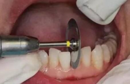 一般在矫正牙齿的过程中,为了解决牙齿拥挤为矫牙留出间隙,可以拔牙