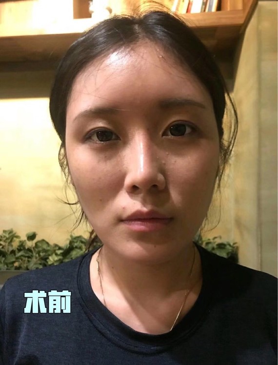 7715面部提升术08术前脸部轮廓松垮,脸颊的肉下垂,导_圈子-新氧