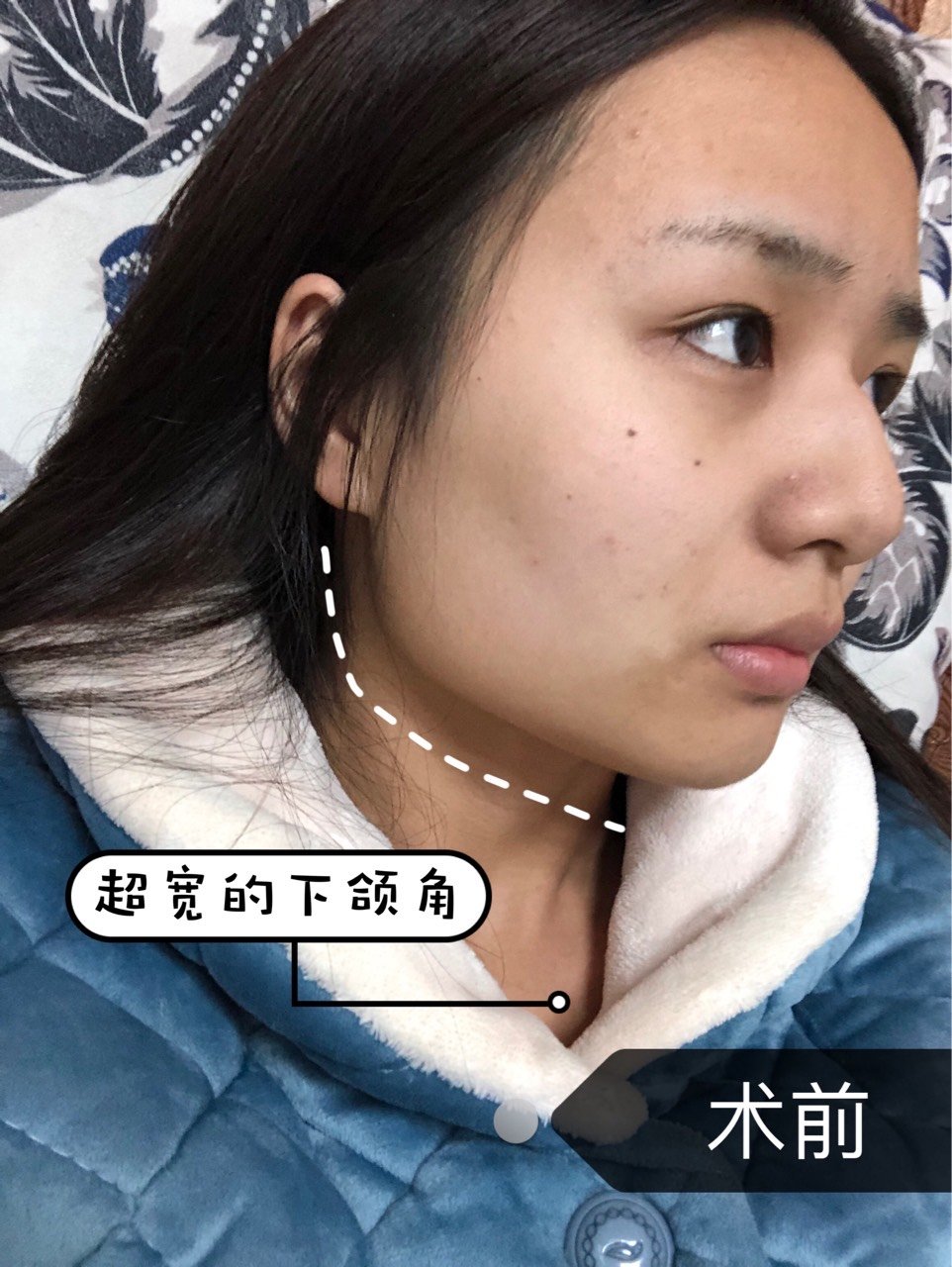 有一类人的下颌骨从侧面看几乎是达到120度的,但是从正面看却是外翻的