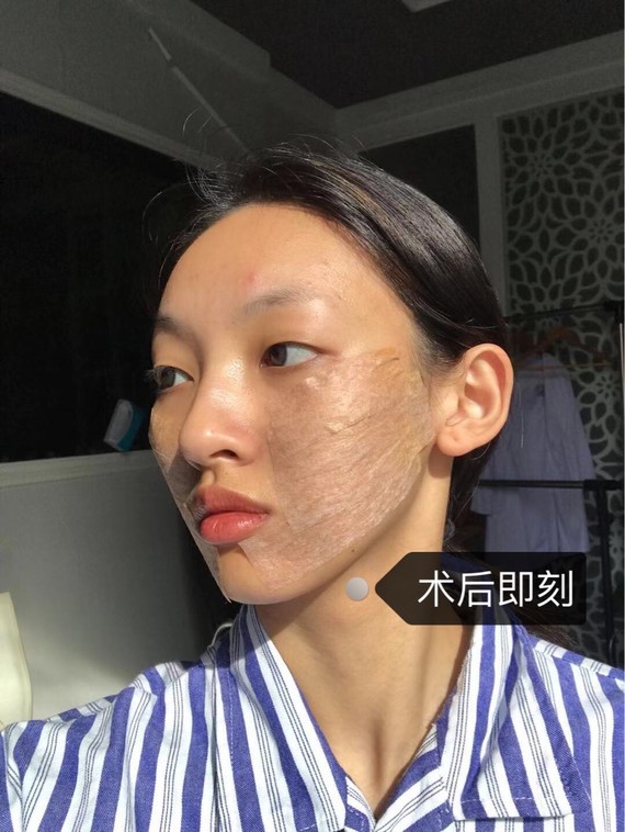 变美项目:面部吸脂