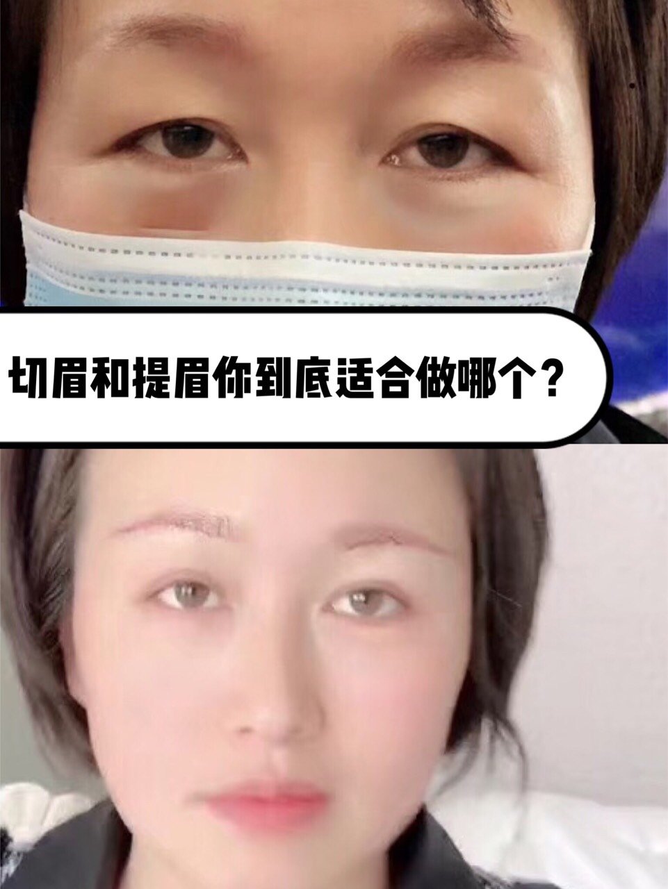 眼皮松弛下垂不做双眼皮怎么改善?