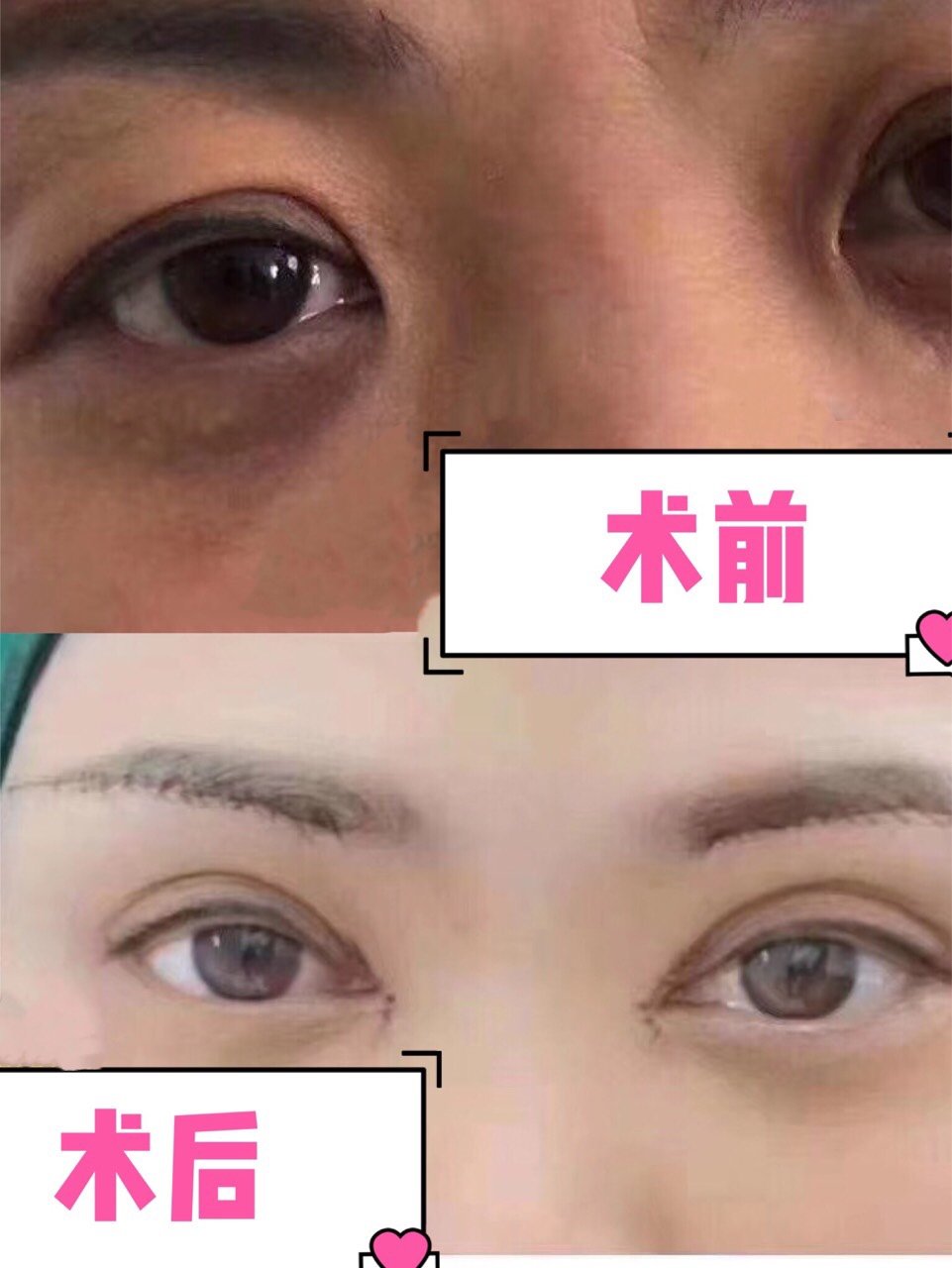 眼皮松弛下垂不做双眼皮怎么改善?