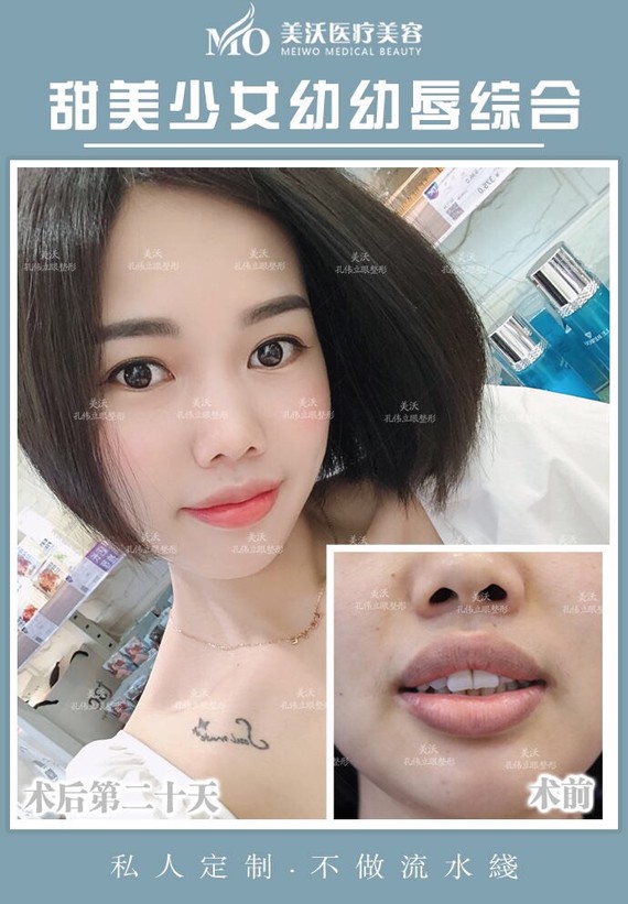 外翻是唇部审美雷区,即使只进行了自然风的塑造,术后