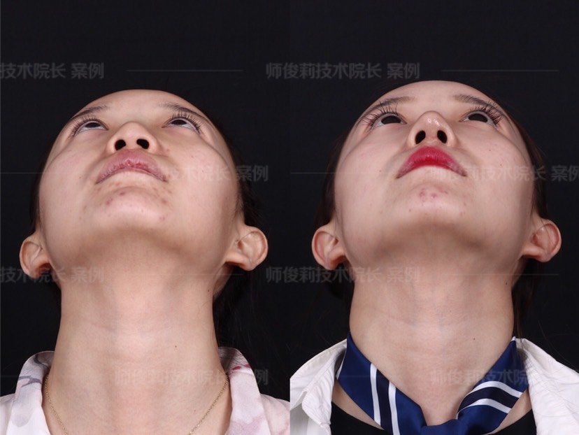 像我这种侧面看上去有高度正面很塌的鼻子怎么解决?要做哪些项目嘞.