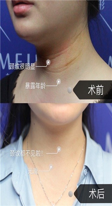 大部位宝宝的颈纹都是横向弧形的体位性颈纹,颈部的皮肤天生就长得