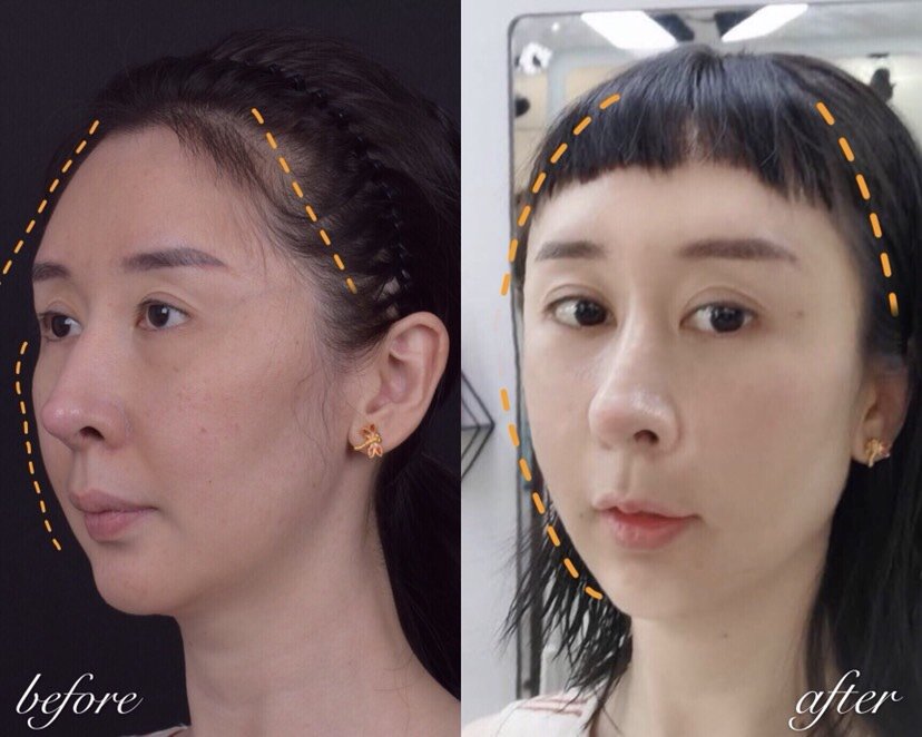 脸大五官不立体年纪轻轻就有泪沟和法令纹