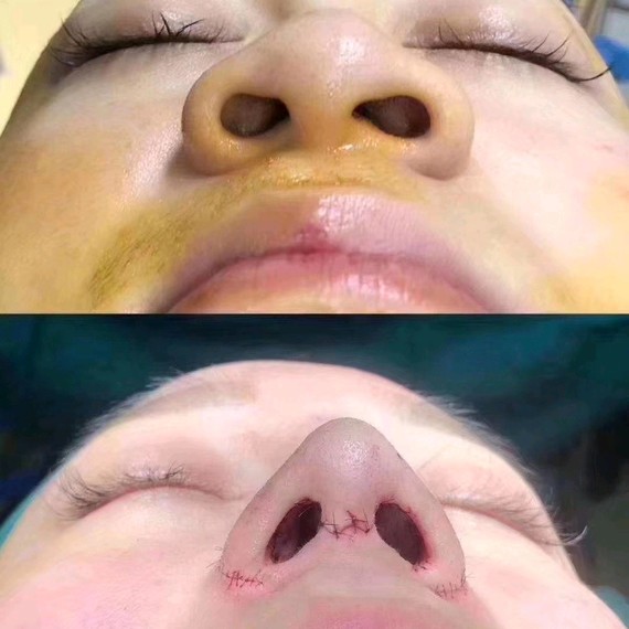 鼻孔不对称该如何矫正?