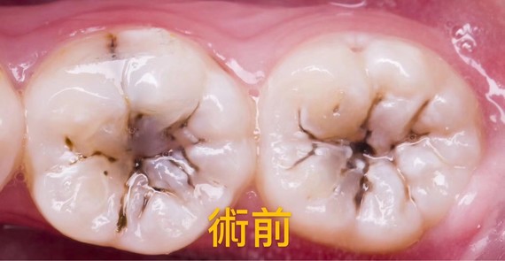 图一看的是多年前银汞材料充填过的,尽管刷牙到不到位