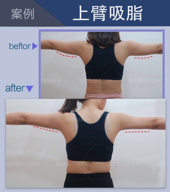 "拜拜肉"大臂内侧腋窝下边松垮下垂的赘肉,显得手臂