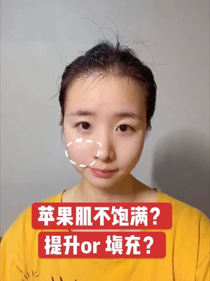 苹果肌不好看想改善?你分清楚_圈子-新氧美容整形