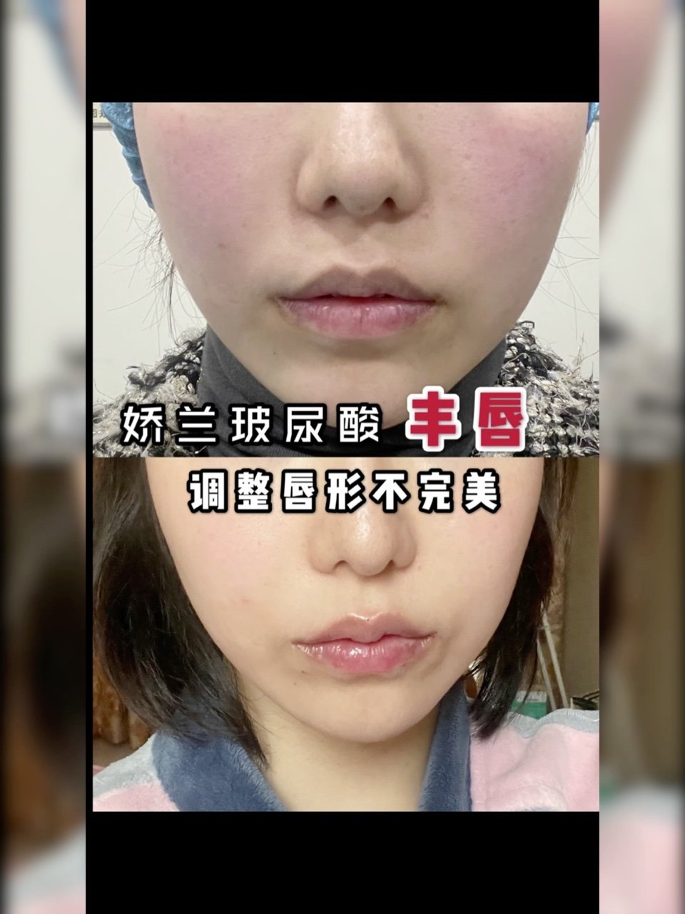 新氧体验官今天体验娇兰玻尿酸丰唇啦一共注射1m_圈子-新氧美容整形