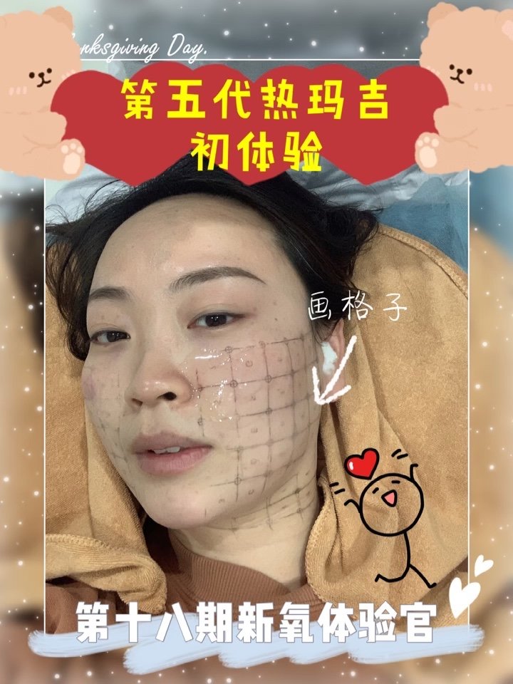 体验官x计划|第五代热玛吉初体验·第十八期新氧体_圈子-新氧美容