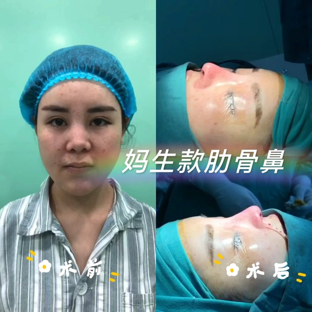 现在最流行的妈生款肋骨鼻术后即刻对比