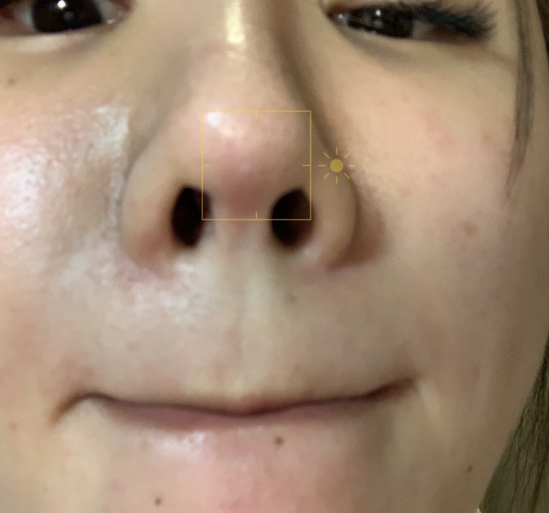 鼻中隔假体隆鼻出现白点