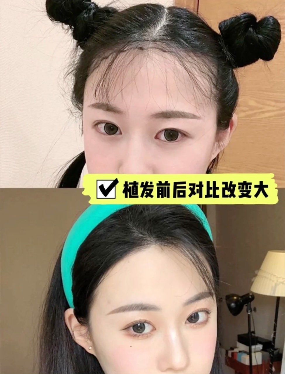 植发案例