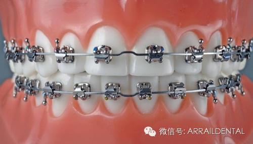 陶瓷托槽和陶瓷自锁托槽_什么叫自锁托槽_自锁托槽 价格