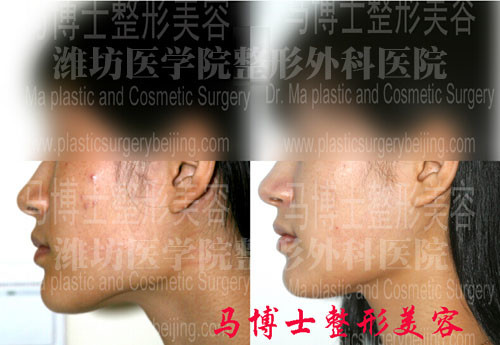 下颌骨及咬肌部分切除术