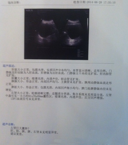 我被查出左肾有一巨大囊肿