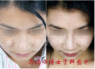 鼻型的分类及其手术方法一,鞍鼻:鼻子低平,医学上称之为 低鼻 或鞍鼻