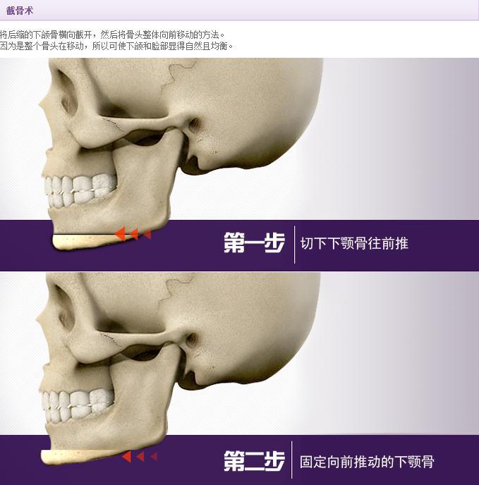 给您流畅自然的下巴线条】下巴整形的适应人群1,小颏畸形严重