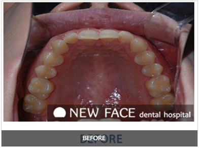 原来的牙齿是向内侧倾斜进去的经过纽菲斯口腔医院5个月的治疗现在的
