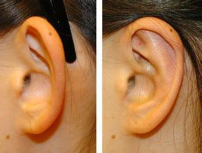 如何治疗招风耳,招风耳呈现一对扁平,前倾的耳朵,看起来可能会感觉有