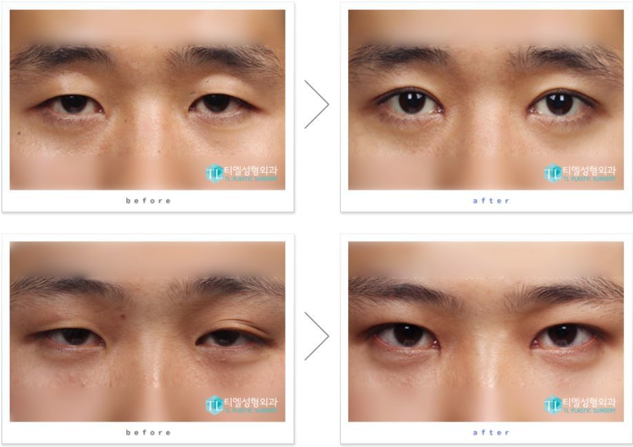 【韩国tl整形医院】男性眼整形的重点是看不出有整过容的痕迹而术后