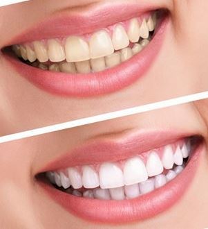 透过牙小管,去除牙齿表面及深层附着的色素,   韩国多仁牙科医院