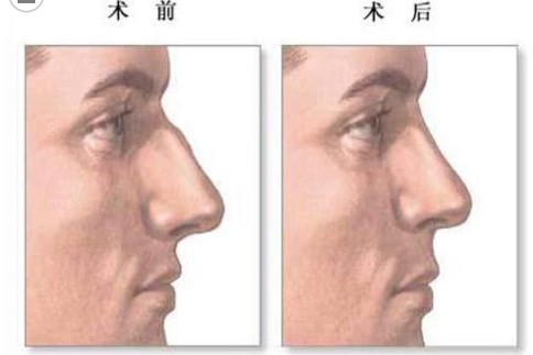 驼峰鼻临床表现为鼻梁部较宽