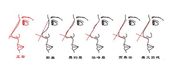 鹰钩鼻是只鼻梁中间部分过度凸出的鼻子,鹰钩鼻会给人强悍的印象.
