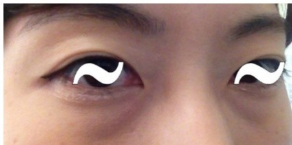 黑眼圈手术后恢复过程
