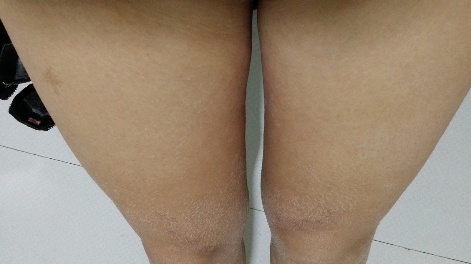 男裆部瘙痒,两边大腿上部靠近裆部,已经有点溃烂,又痒