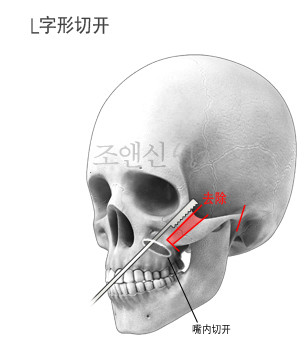 颧骨缩小术为此什么可以防止面颊下垂