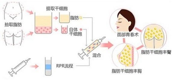 警示:水动力吸脂也有"山寨"版!