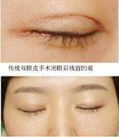如何避免切开重睑术后留下明显疤痕?