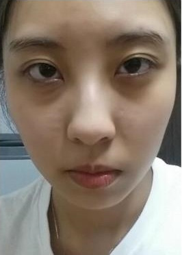多层双眼皮完美整理, 术后4个月效果