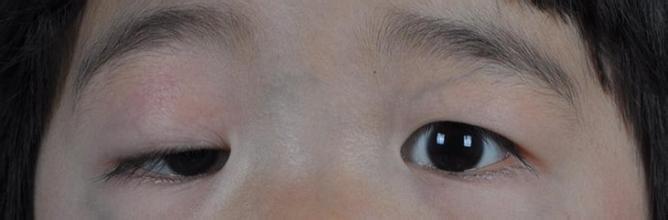 上睑下垂俗称"大眼皮",是由于提上睑肌功能障碍不能开