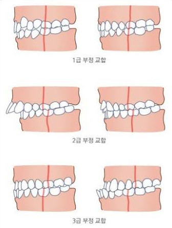 牙齿咬合不正有哪些分类?