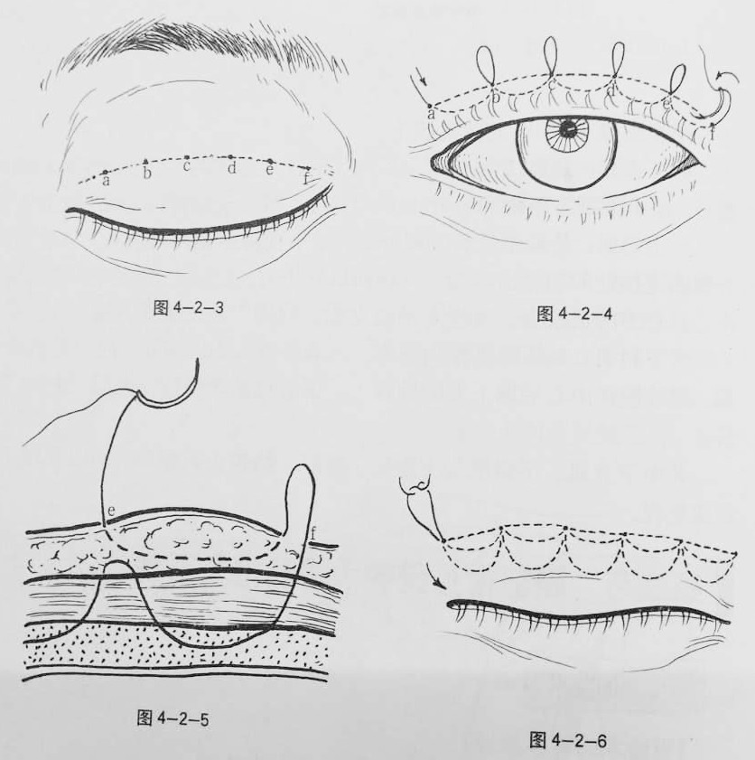 连续埋线法