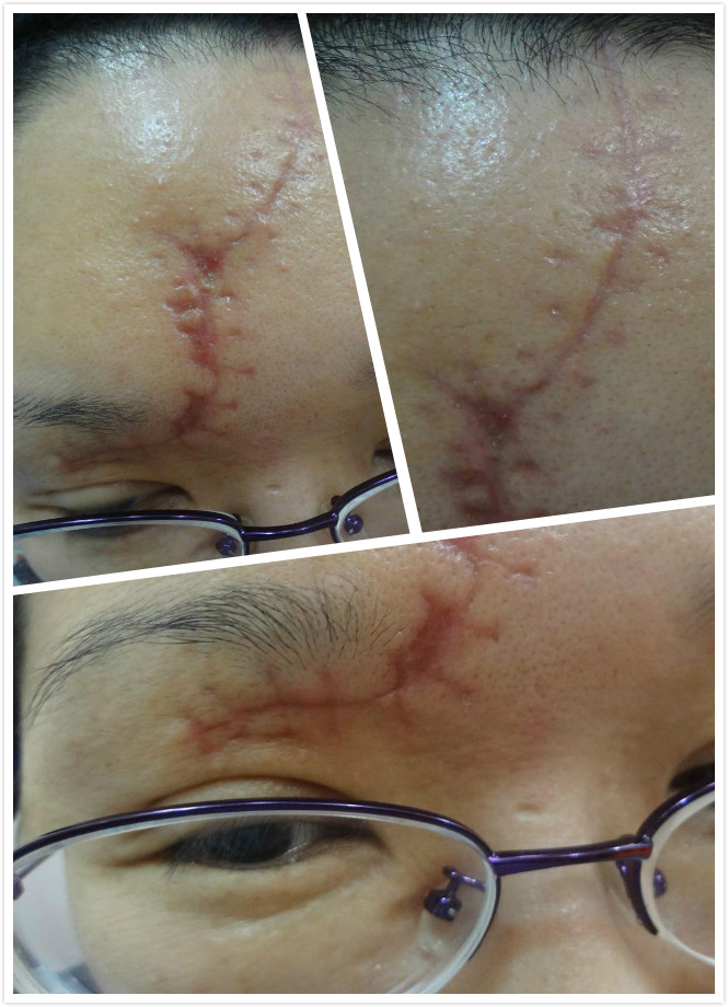 济南韩氏整形美容医院祛除疤痕术后一个多月,我脸上