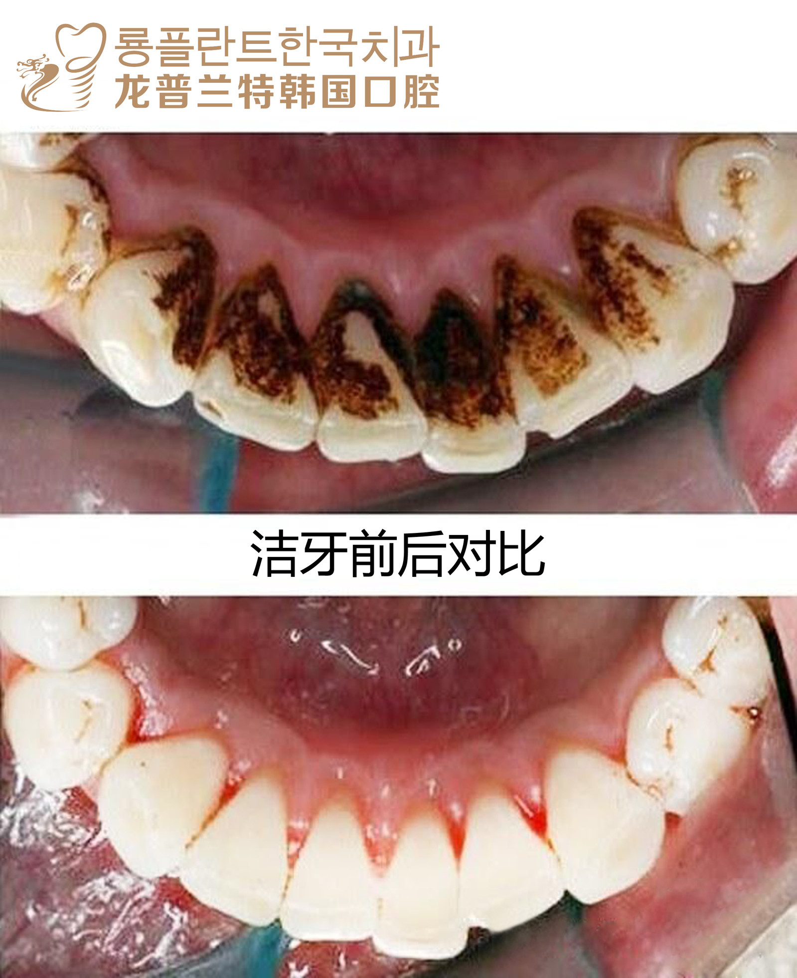 【洗牙】单人超声波洁牙套餐 洁牙 抛光 口腔检查