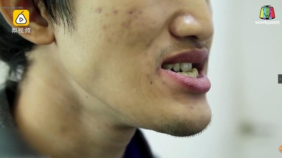 这张图可以明显看出地包天的问题,导致下颚突出.