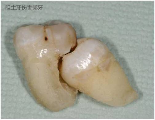 你的智齿需要拔吗?我们所说的智齿，也就是第三磨牙或俗称“近根牙”，是人类_圈子-新氧美容整形