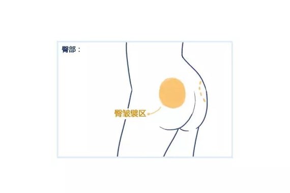 吸脂瘦大腿,该吸哪里呢?